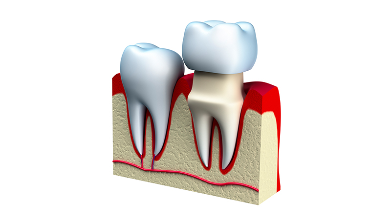 Prostodoncia en Huesca Alins Clinica Dental